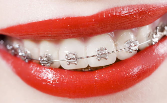 Combien cela coûte-t-il de redresser vos dents avec des appareils orthodontiques en 2019