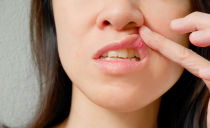 Tratamento de estomatite na boca em adultos em casa