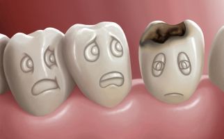 تسوس الأسنان: ما هو ، أنواع ، مراحل ، وكيفية علاجها