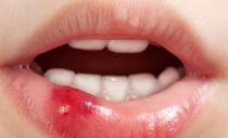 Swollen lip: causes, treatment of edema of the lower and upper lip