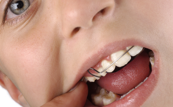 เครื่องมือจัดฟันติดฟัน: สิ่งที่จำเป็น, ประเภท, การติดตั้ง