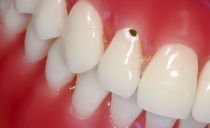 Carie cervicale alla base del dente: cause, trattamento, prevenzione