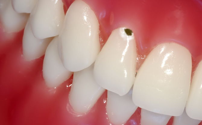 Caries cervicales à la base de la dent: causes, traitement, prévention