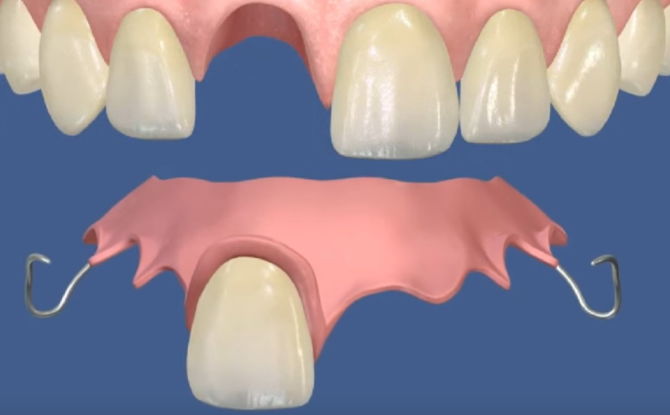 A hamis fogak típusai, melyeket jobban be lehet illeszteni