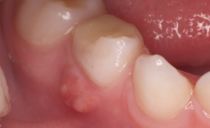 En abscess på tannkjøttet: årsaker, hvordan du behandler
