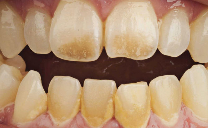 Bagaimana dan bagaimana untuk membersihkan gigi dari plak di rumah