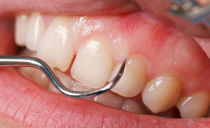 Tại sao răng bị đau dưới thân răng và phải làm gì với nó