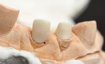 Stump tab for teeth under the crown: what is it, types, cost