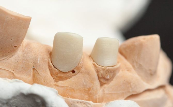Onglet de moignon pour les dents sous la couronne: qu'est-ce que c'est, types, coût