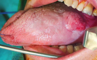 Tumor en la superficie lateral de la lengua.