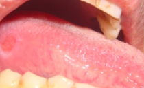 Magesår i tungen: grunner til at dukker opp, hvordan du behandler