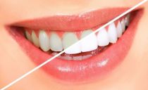 Professional and independent teeth whitening