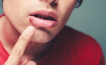 Quais pílulas e drogas podem curar feridas nos lábios