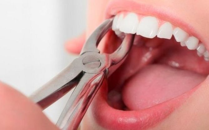 How much does a tooth extraction cost, where can I remove a tooth for free and around the clock