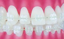 Sapphire braces: advantages, disadvantages, installation, photo before and after