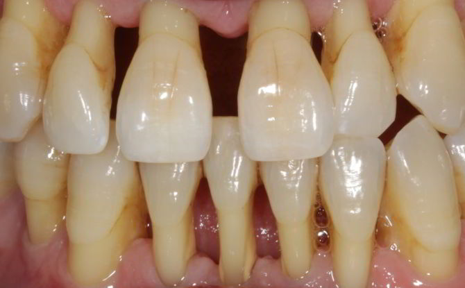 Cómo salvar los dientes durante la enfermedad periodontal: remedios caseros y medicamentos, tratamiento a base de hierbas.