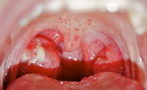 Causes of red rash in the palate, in the throat and on the oral mucosa in adults and children