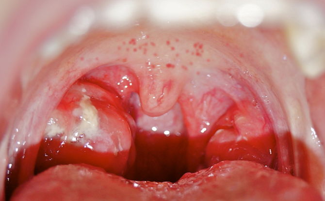 Causas de erupção cutânea vermelha no palato, na garganta e na mucosa oral em adultos e crianças
