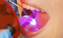 Light fillings for teeth: what is it, the pros and cons, installation steps, service life
