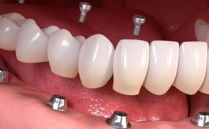 Оцјена зубних имплантата од стране произвођача