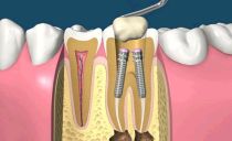 A pin in a tooth: what is it, how are they put, types, cost
