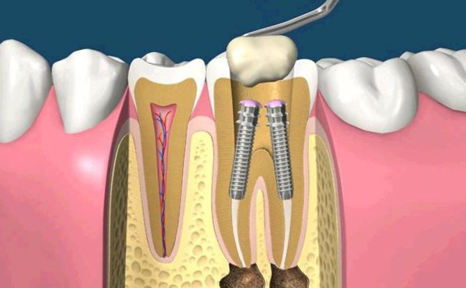 Pin dalam gigi: apa itu, bagaimana mereka meletakkan, jenis, kos