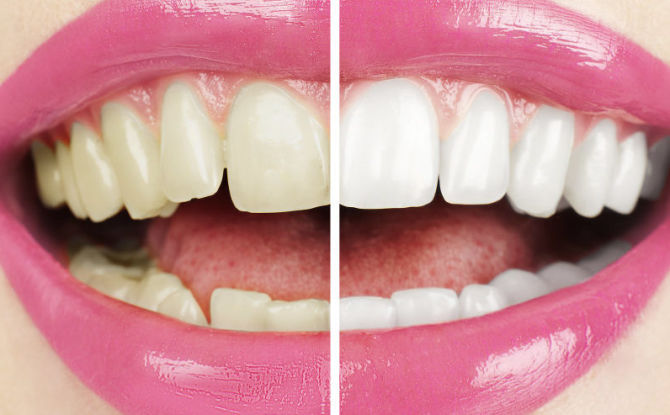 How to quickly whiten your teeth at home in 1 day