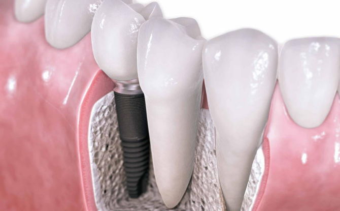 Cât costă introducerea unui dinte: tipuri și costuri ale dinților false