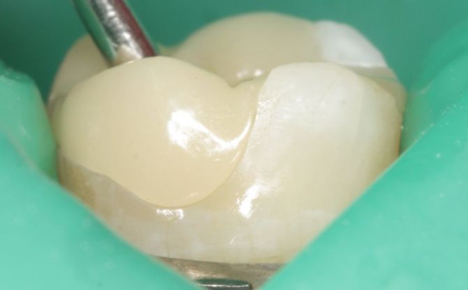 Un relleno temporal en el diente: por qué se coloca, cuánto retiene, cómo se extrae