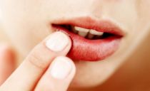 Trattamento rapido per l'herpes sulle labbra a casa