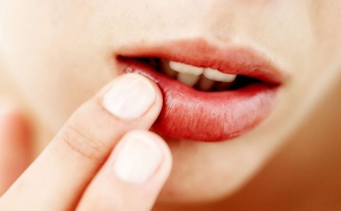 Tratamiento rápido para el herpes en los labios en casa.