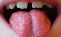 Mengapa jerawat dan jerawat merah dan putih muncul pada lidah seorang kanak-kanak