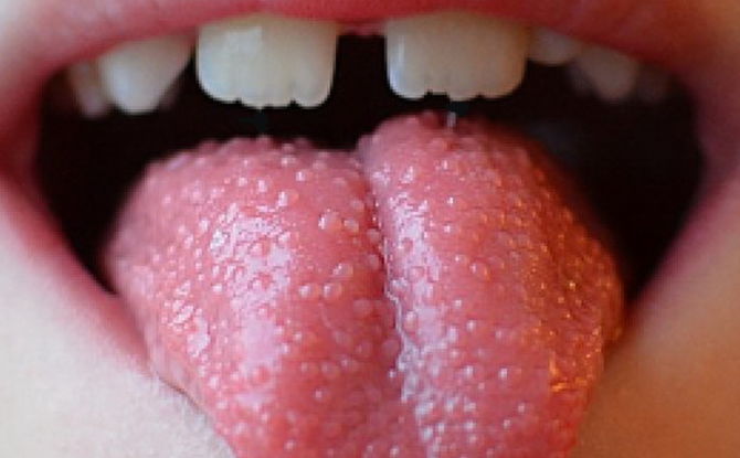 Hvorfor vises røde og hvite kviser og kviser på tungen til et barn