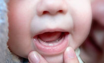 Stomatitas kūdikiams: požymiai, simptomai, gydymas, nuotrauka