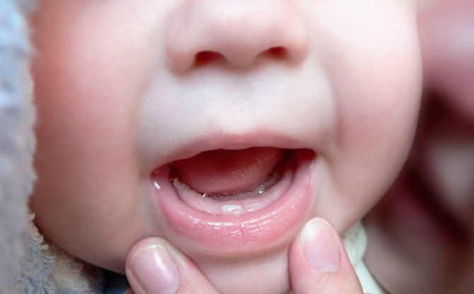 التهاب الفم عند الرضع: علامات ، أعراض ، علاج ، صورة
