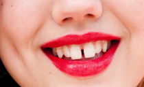 Khoảng cách giữa các răng: tại sao chúng xuất hiện và làm thế nào để loại bỏ
