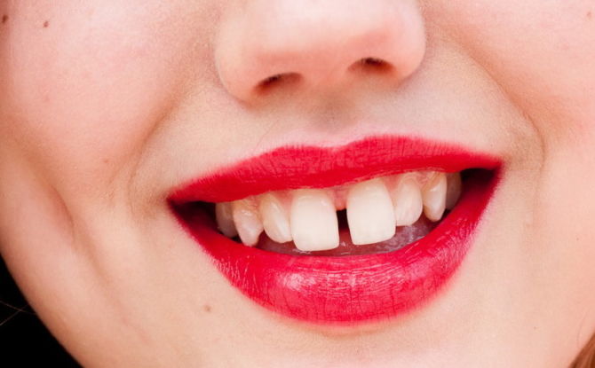 Mezery mezi zuby: proč se objevují a jak je odstranit