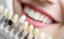 Veneers on the teeth: what is it