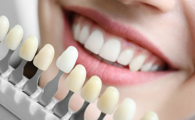 Veneers on the teeth: what is it