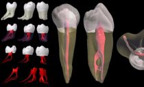 Remoção de nervo dental: como e em que casos são removidos, as consequências
