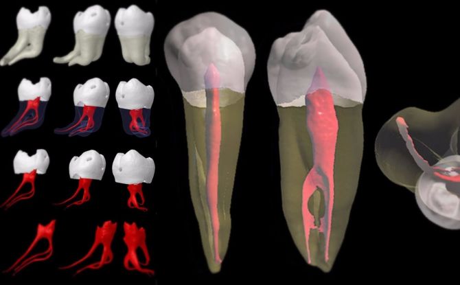 Dental nerv borttagning: hur och i vilka fall tas bort, konsekvenserna