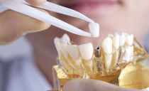 اختيار أطقم الأسنان مع غياب جزئي للأسنان: أيهما أفضل