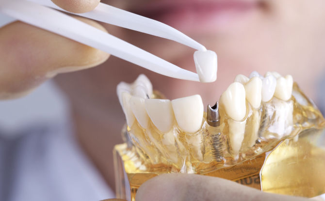Pilihan gigi palsu dengan ketiadaan sebahagian gigi: yang lebih baik