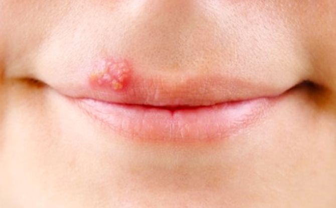 Bump trên môi từ bên trong và bên ngoài: nó là gì, điều trị