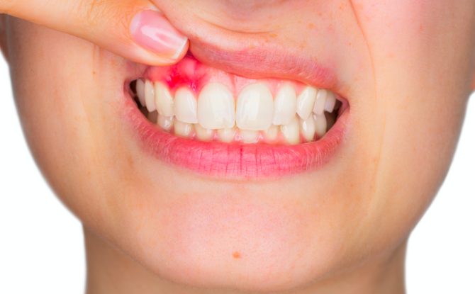 Fistulė ant dantenų: priežastys, gydymas