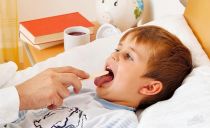Stomatit hos barn och spädbarn: symtom, behandling, förebyggande