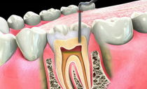 Um dente dói após a remoção do nervo e o preenchimento do canal: por que e o que fazer