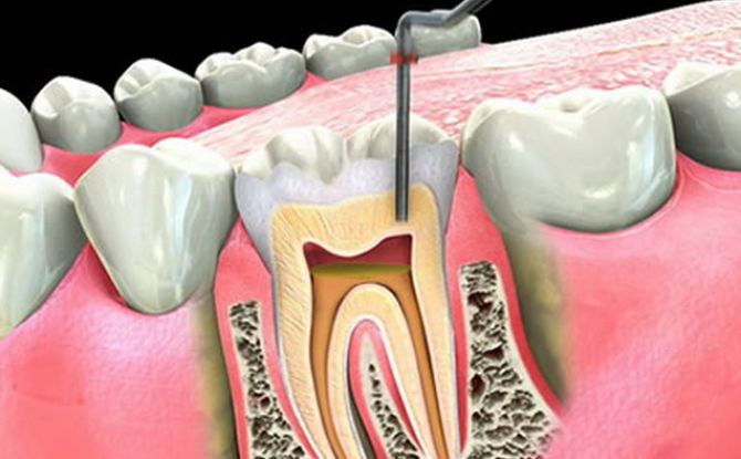 En tand gör ont efter nervborttagning och kanalfyllning: varför och vad man ska göra