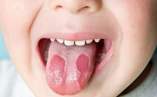 Тачке и плакови на језику код деце и одојчади: врсте, узроци, дијагноза и методе лечења