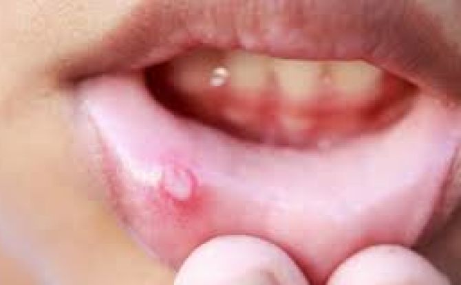 Inflamación de la mucosa oral: causas y tratamiento.